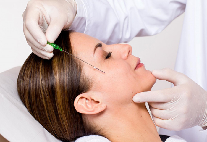 4-Lifting-facial-con-hilos-tensores