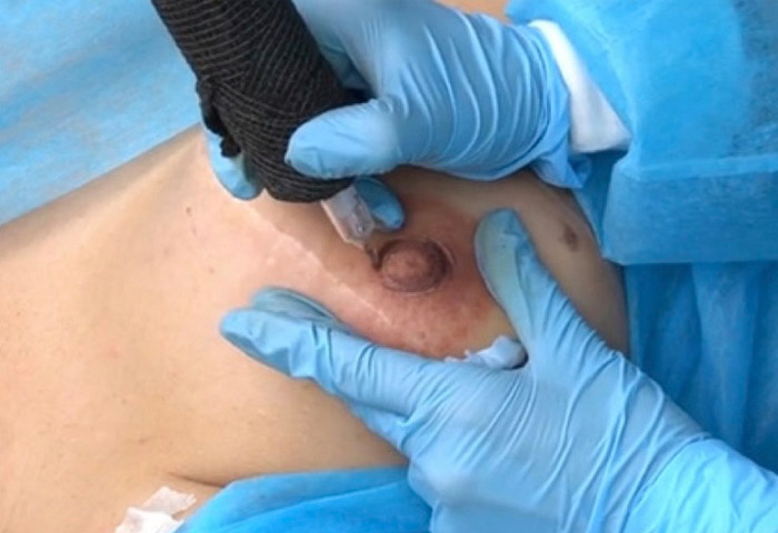 4-Micropigmentacion-de-areolas-y-pezones